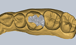 インレー・アンレー