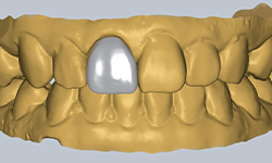 シングルクラウン1